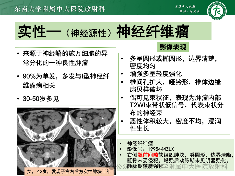 影像PPT - 【PPT】女性盆腔内腹膜外占位性病变-39