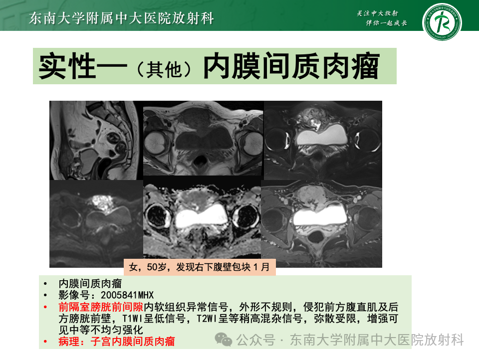 影像PPT - 【PPT】女性盆腔内腹膜外占位性病变-43
