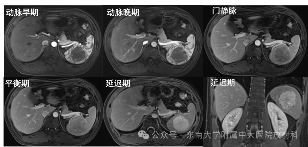 影像PPT - 【PPT】脾脏硬化性血管瘤样结节性转化-3 影像PPT - 【PPT】脾脏硬化性血管瘤样结节性转化-3