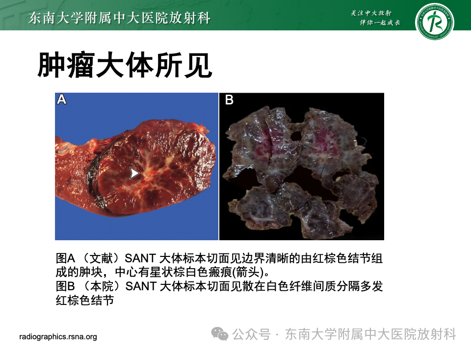 影像PPT - 【PPT】脾脏硬化性血管瘤样结节性转化-9 影像PPT - 【PPT】脾脏硬化性血管瘤样结节性转化-9