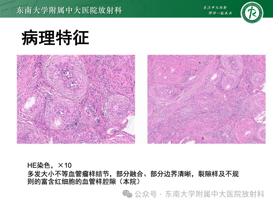 影像PPT - 【PPT】脾脏硬化性血管瘤样结节性转化-10 影像PPT - 【PPT】脾脏硬化性血管瘤样结节性转化-10