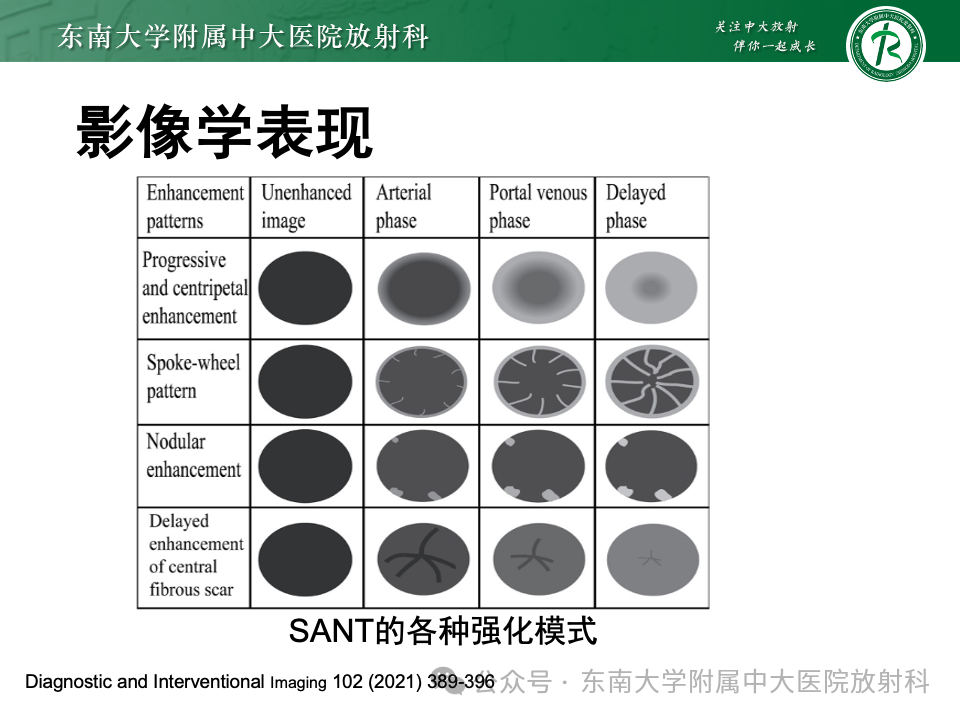 影像PPT - 【PPT】脾脏硬化性血管瘤样结节性转化-13 影像PPT - 【PPT】脾脏硬化性血管瘤样结节性转化-13