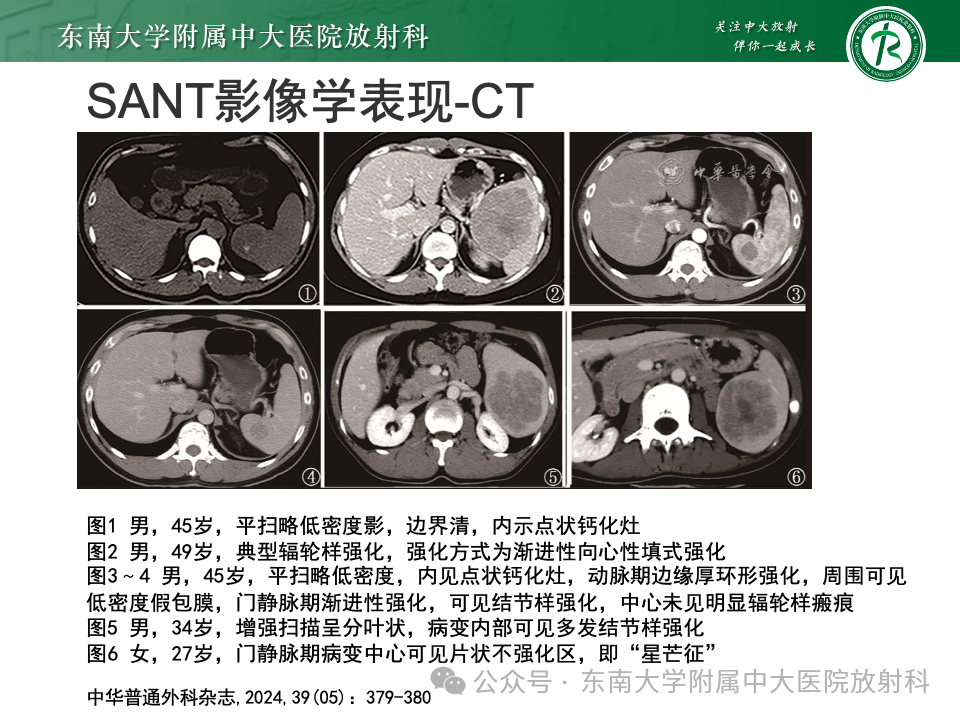 影像PPT - 【PPT】脾脏硬化性血管瘤样结节性转化-14 影像PPT - 【PPT】脾脏硬化性血管瘤样结节性转化-14