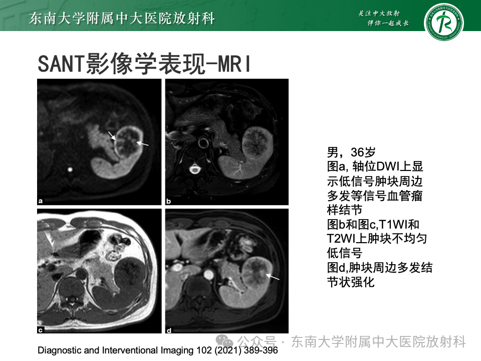 影像PPT - 【PPT】脾脏硬化性血管瘤样结节性转化-15 影像PPT - 【PPT】脾脏硬化性血管瘤样结节性转化-15