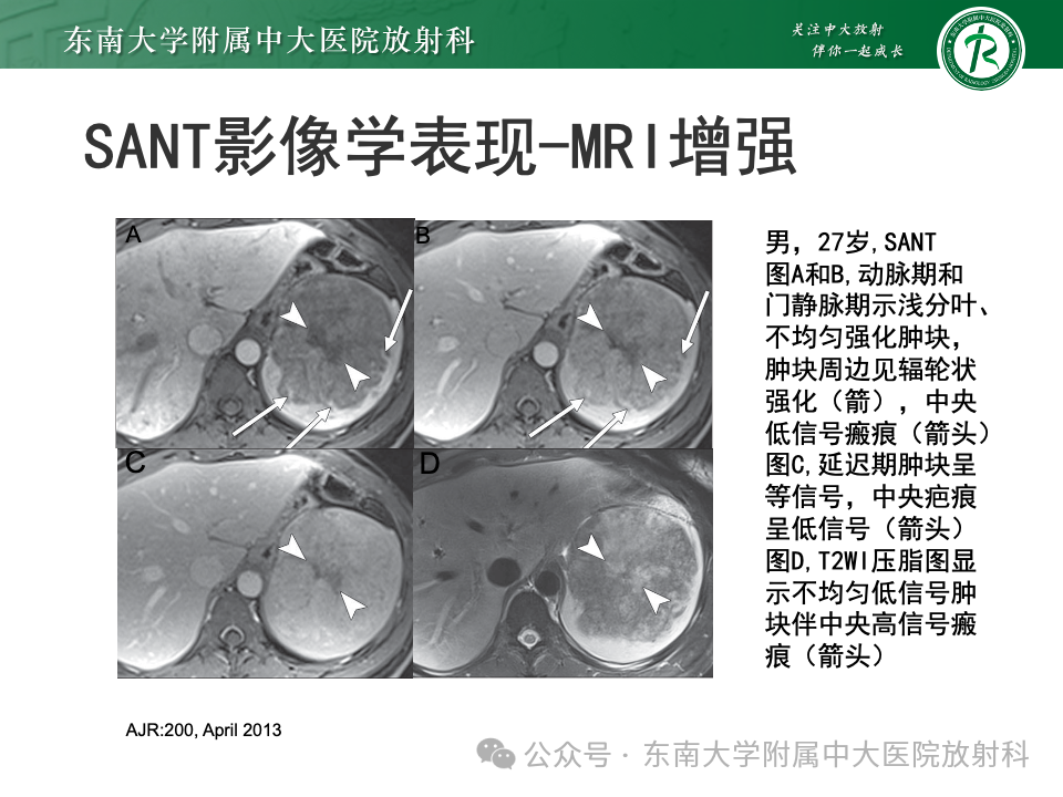 影像PPT - 【PPT】脾脏硬化性血管瘤样结节性转化-16 影像PPT - 【PPT】脾脏硬化性血管瘤样结节性转化-16
