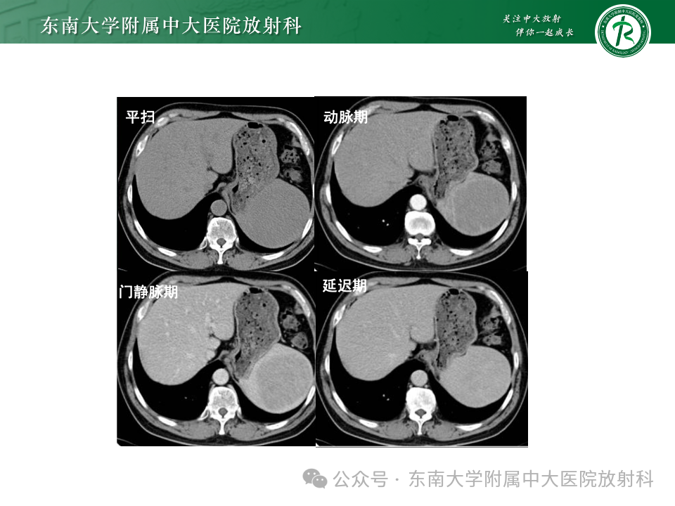 影像PPT - 【PPT】脾脏硬化性血管瘤样结节性转化-18 影像PPT - 【PPT】脾脏硬化性血管瘤样结节性转化-18