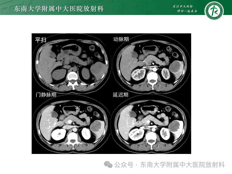 影像PPT - 【PPT】脾脏硬化性血管瘤样结节性转化-17 影像PPT - 【PPT】脾脏硬化性血管瘤样结节性转化-17