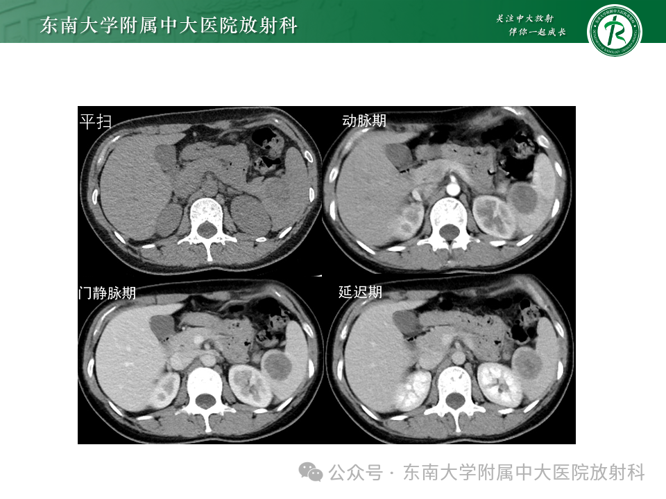 影像PPT - 【PPT】脾脏硬化性血管瘤样结节性转化-19 影像PPT - 【PPT】脾脏硬化性血管瘤样结节性转化-19