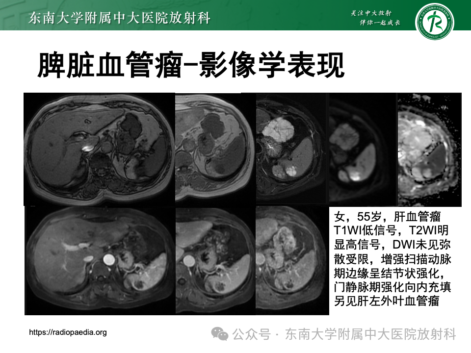 影像PPT - 【PPT】脾脏硬化性血管瘤样结节性转化-23 影像PPT - 【PPT】脾脏硬化性血管瘤样结节性转化-23