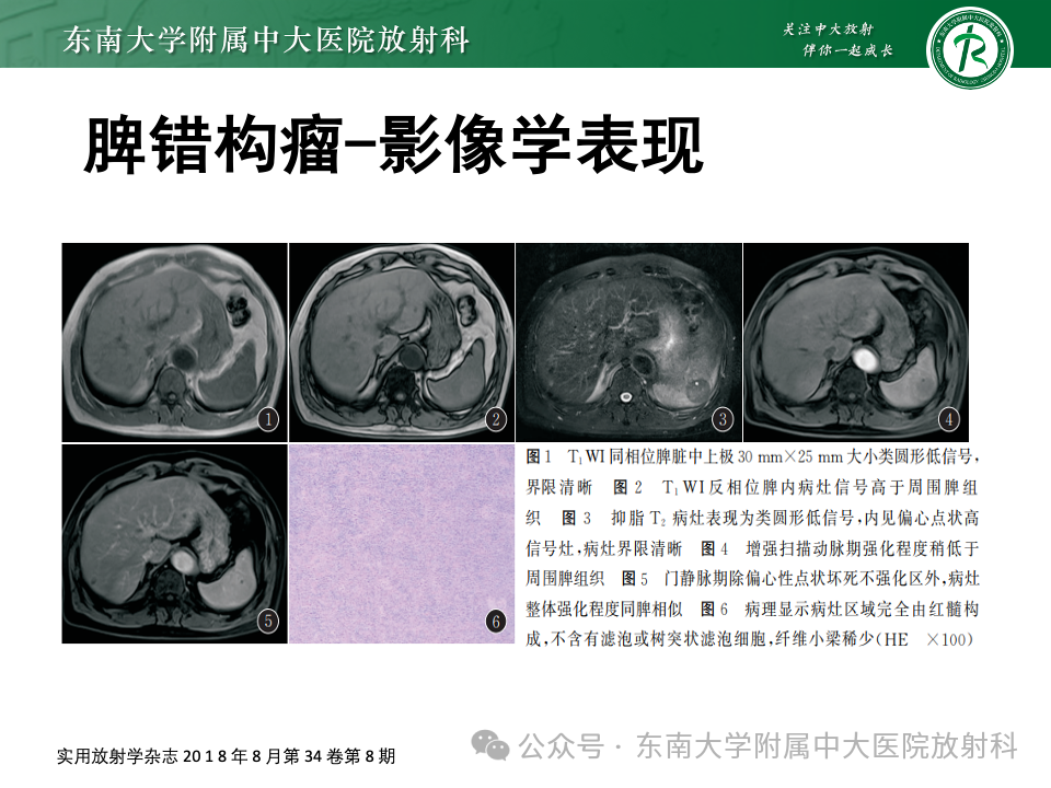 影像PPT - 【PPT】脾脏硬化性血管瘤样结节性转化-28 影像PPT - 【PPT】脾脏硬化性血管瘤样结节性转化-28