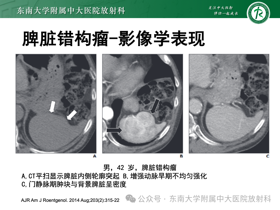 影像PPT - 【PPT】脾脏硬化性血管瘤样结节性转化-27 影像PPT - 【PPT】脾脏硬化性血管瘤样结节性转化-27