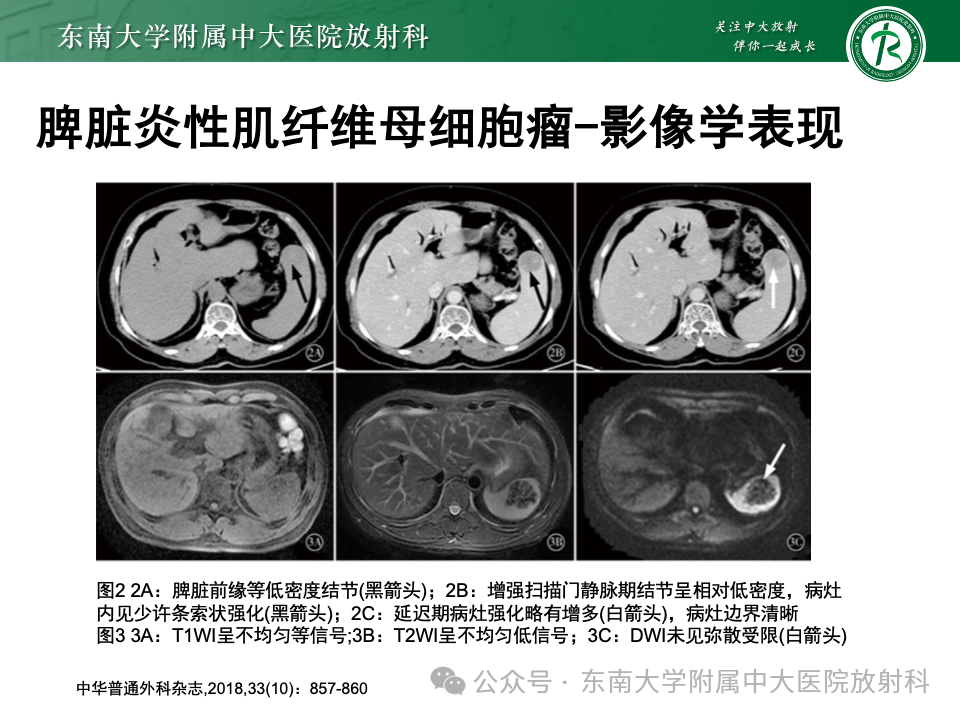 影像PPT - 【PPT】脾脏硬化性血管瘤样结节性转化-32 影像PPT - 【PPT】脾脏硬化性血管瘤样结节性转化-32