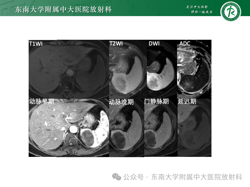 影像PPT - 【PPT】脾脏硬化性血管瘤样结节性转化-33 影像PPT - 【PPT】脾脏硬化性血管瘤样结节性转化-33