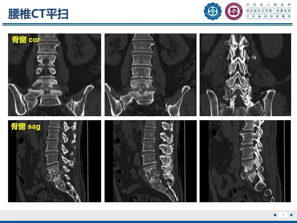 影像PPT - 【PPT】脊柱结核-5