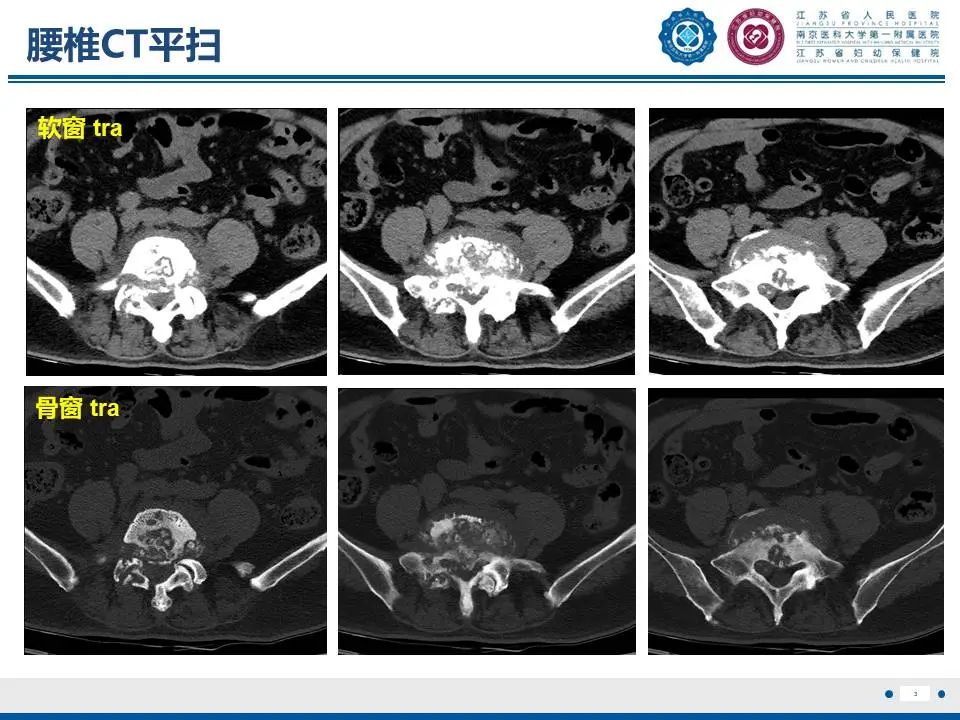 影像PPT - 【PPT】脊柱结核-4