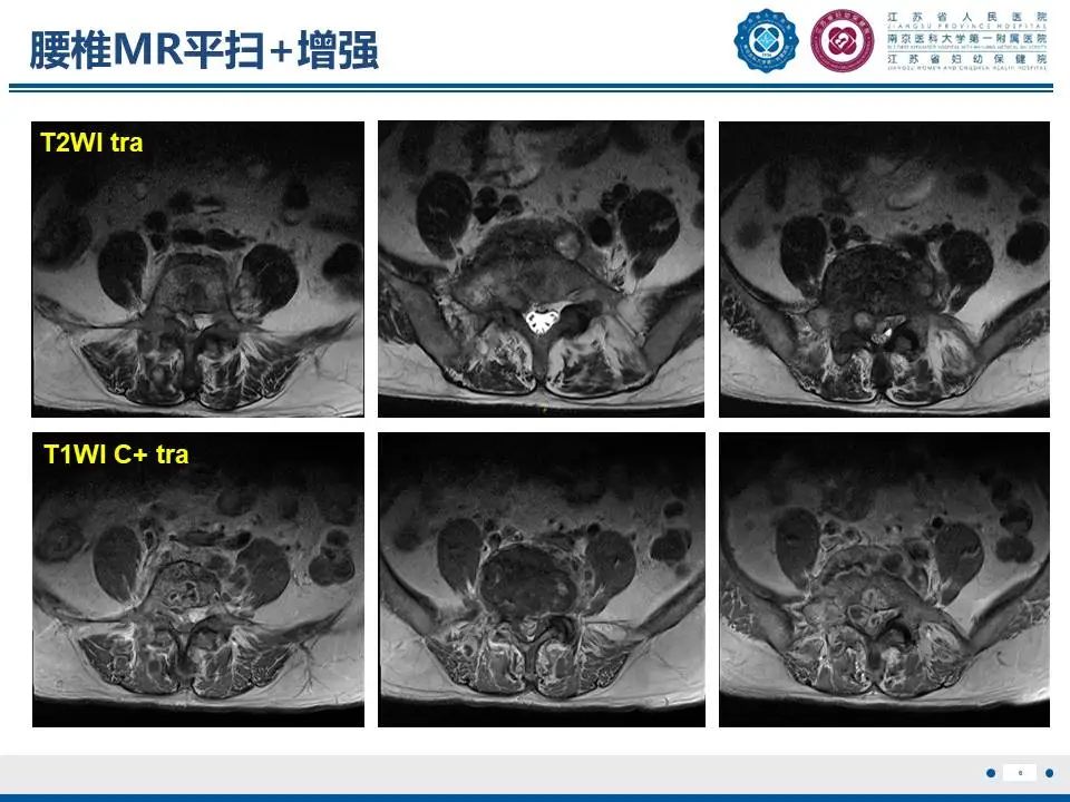 影像PPT - 【PPT】脊柱结核-7