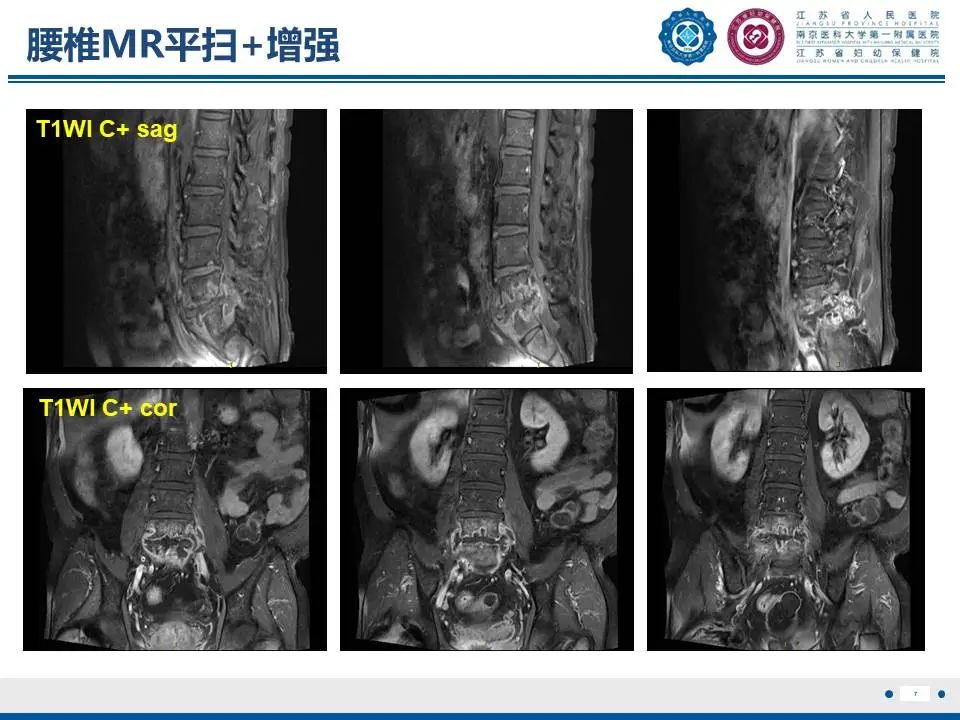 影像PPT - 【PPT】脊柱结核-8