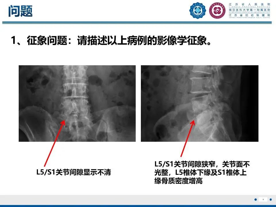 影像PPT - 【PPT】脊柱结核-10