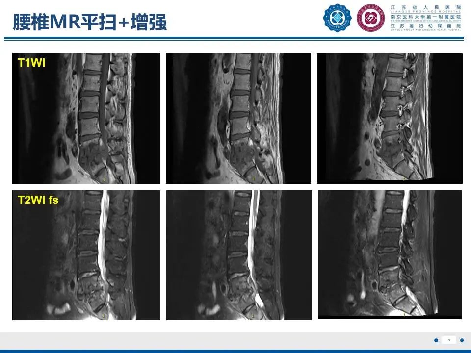 影像PPT - 【PPT】脊柱结核-6