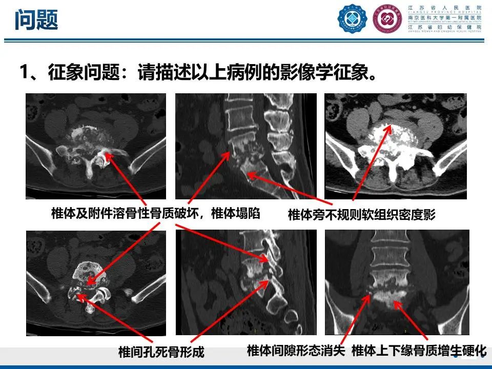 影像PPT - 【PPT】脊柱结核-11