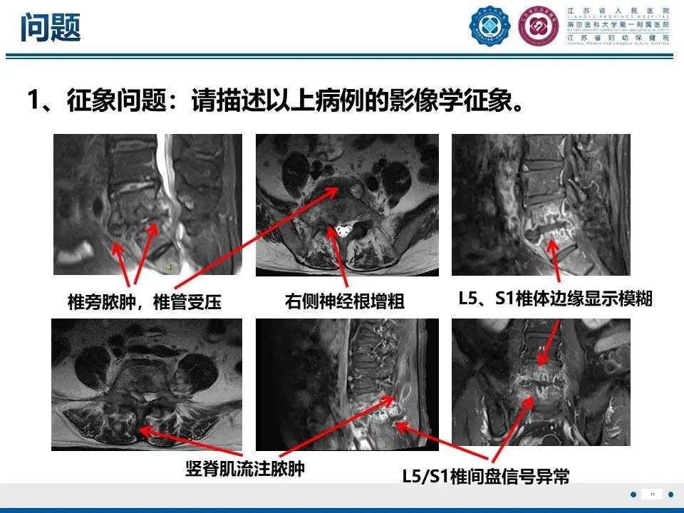 影像PPT - 【PPT】脊柱结核-12