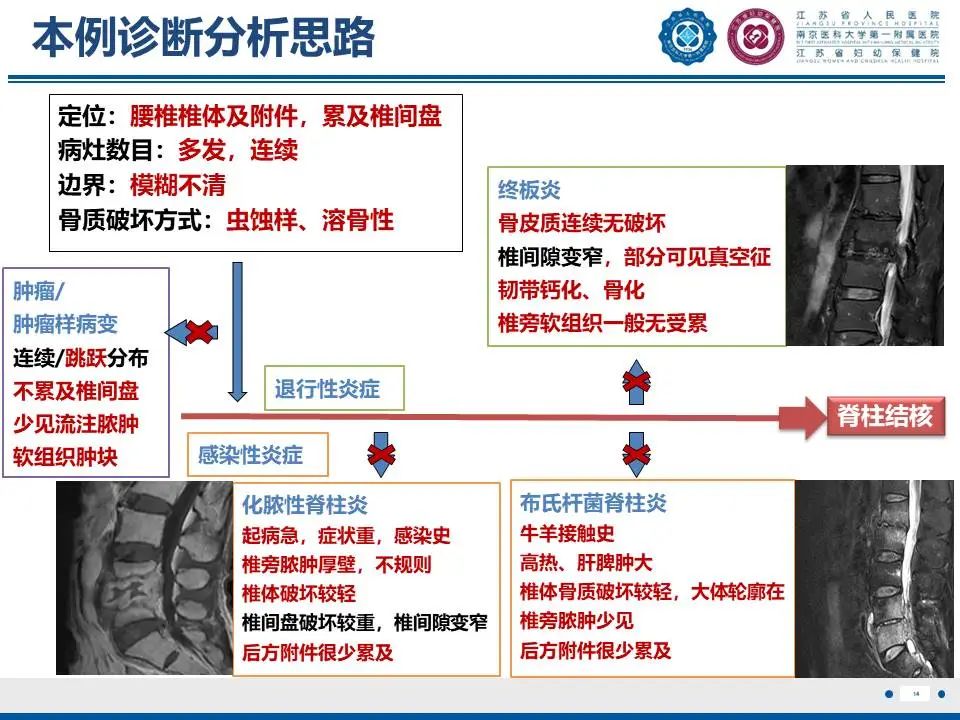 影像PPT - 【PPT】脊柱结核-15