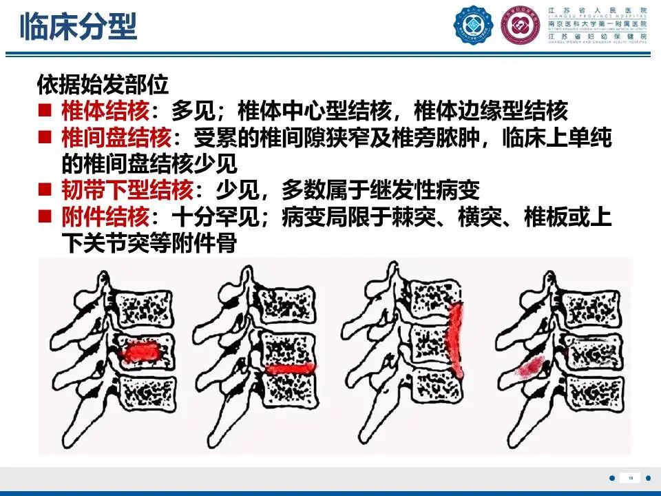 影像PPT - 【PPT】脊柱结核-19