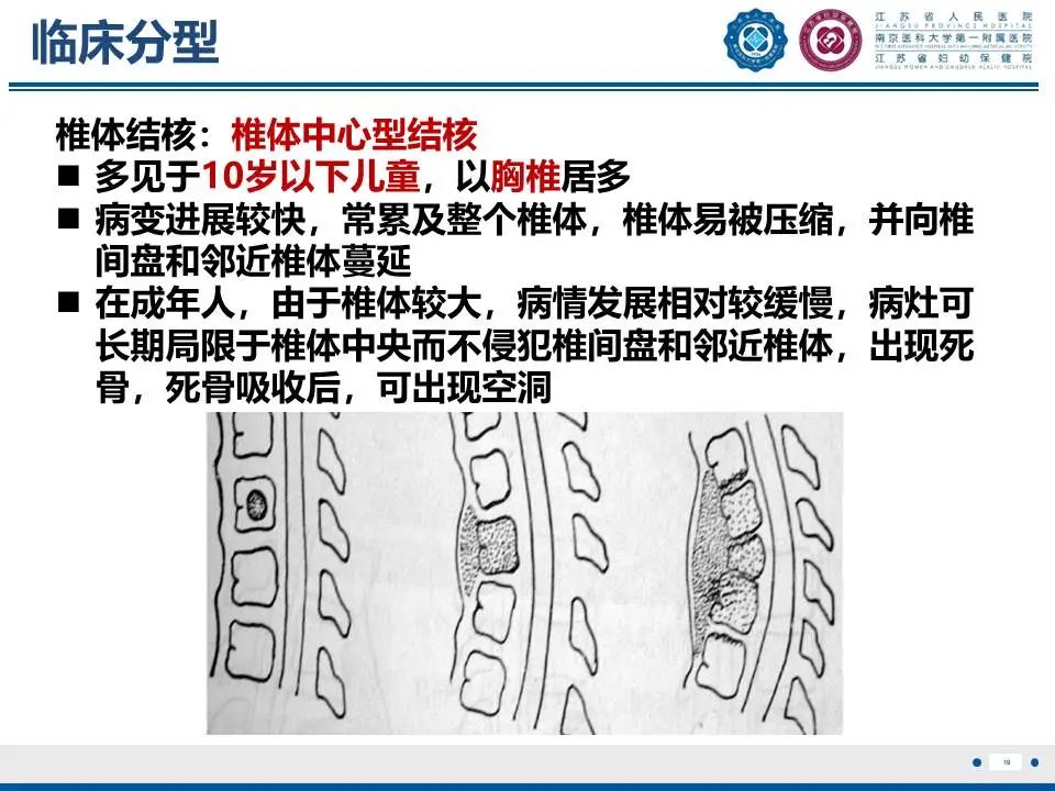 影像PPT - 【PPT】脊柱结核-20