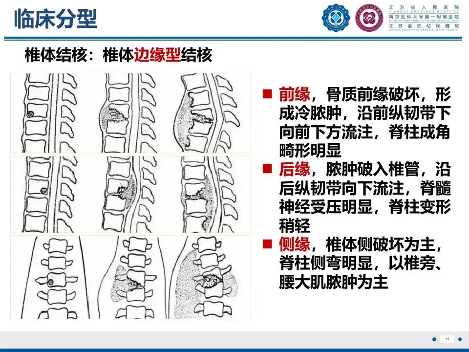影像PPT - 【PPT】脊柱结核-22