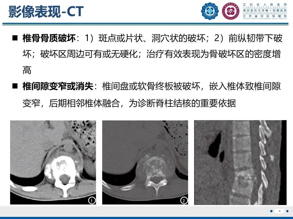 影像PPT - 【PPT】脊柱结核-24