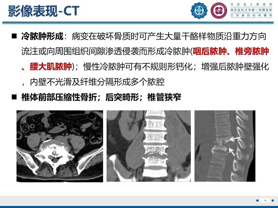 影像PPT - 【PPT】脊柱结核-25