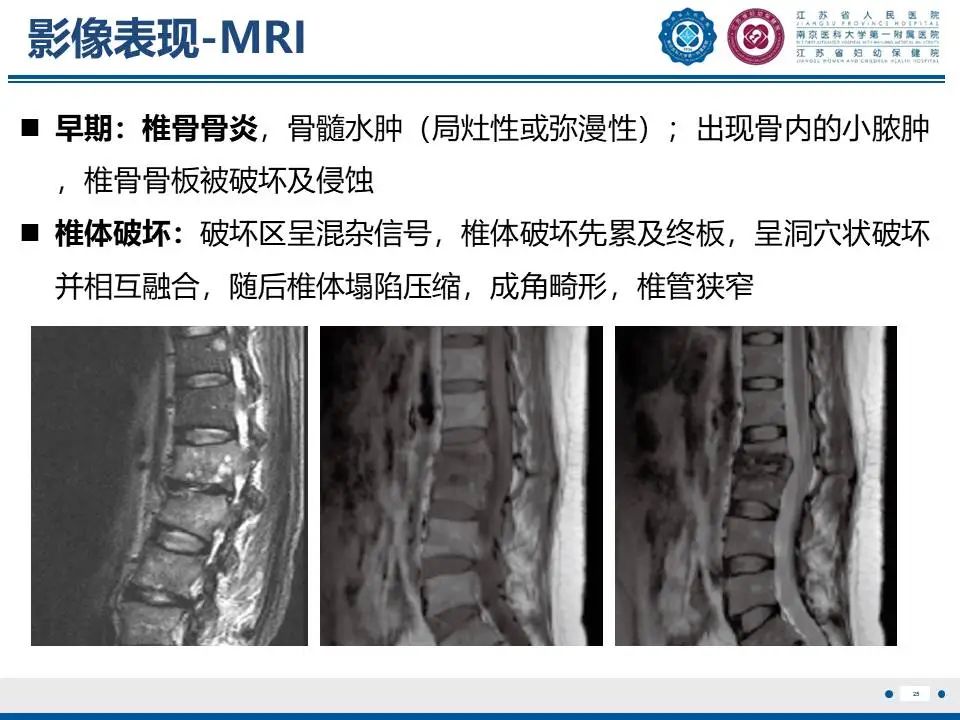 影像PPT - 【PPT】脊柱结核-26
