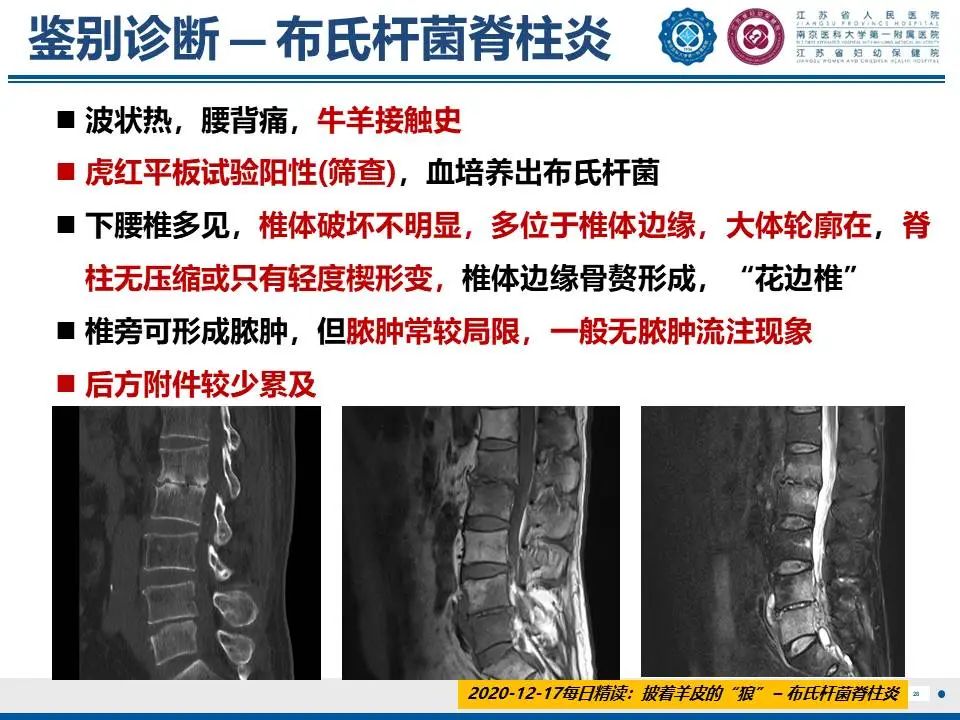 影像PPT - 【PPT】脊柱结核-29