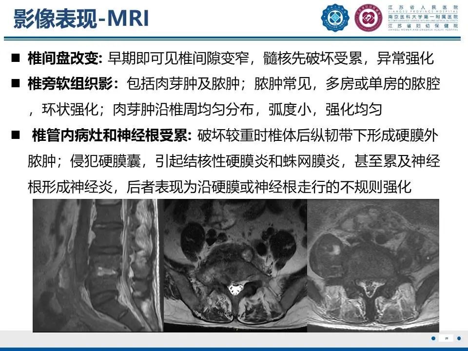 影像PPT - 【PPT】脊柱结核-27