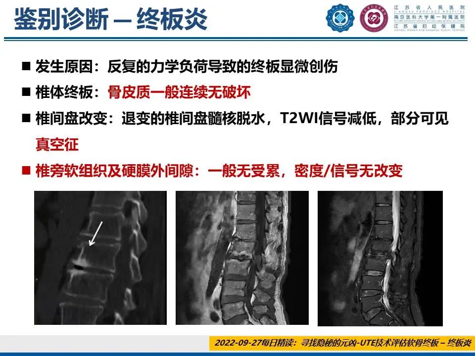 影像PPT - 【PPT】脊柱结核-30