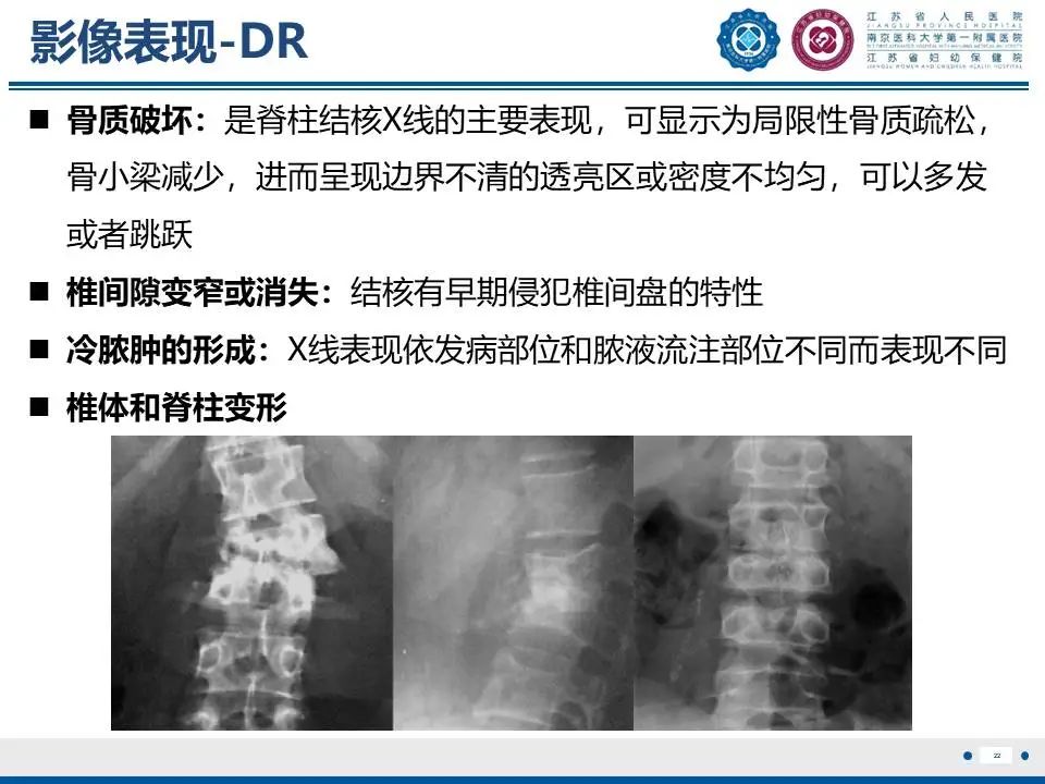 影像PPT - 【PPT】脊柱结核-23