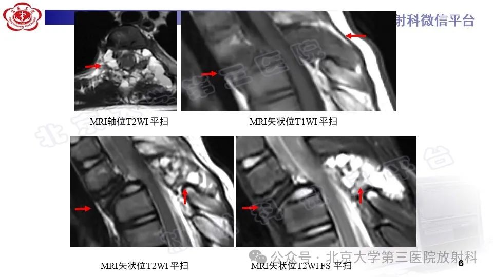 影像PPT - 【PPT】胸椎动脉瘤样骨囊肿-5