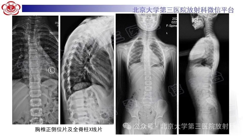影像PPT - 【PPT】胸椎动脉瘤样骨囊肿-3