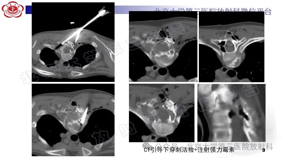 影像PPT - 【PPT】胸椎动脉瘤样骨囊肿-8
