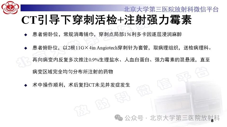 影像PPT - 【PPT】胸椎动脉瘤样骨囊肿-7