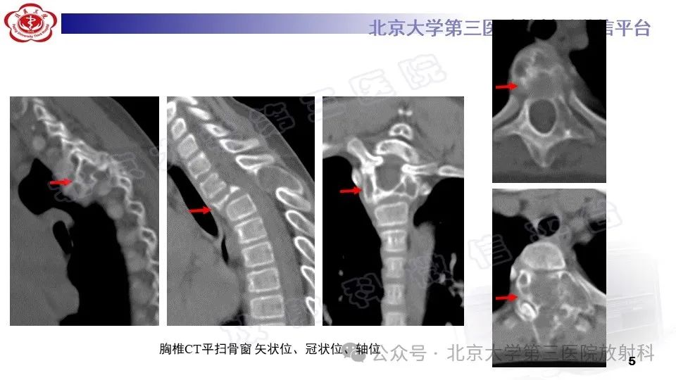 影像PPT - 【PPT】胸椎动脉瘤样骨囊肿-4