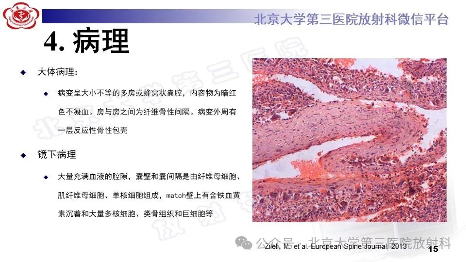影像PPT - 【PPT】胸椎动脉瘤样骨囊肿-14