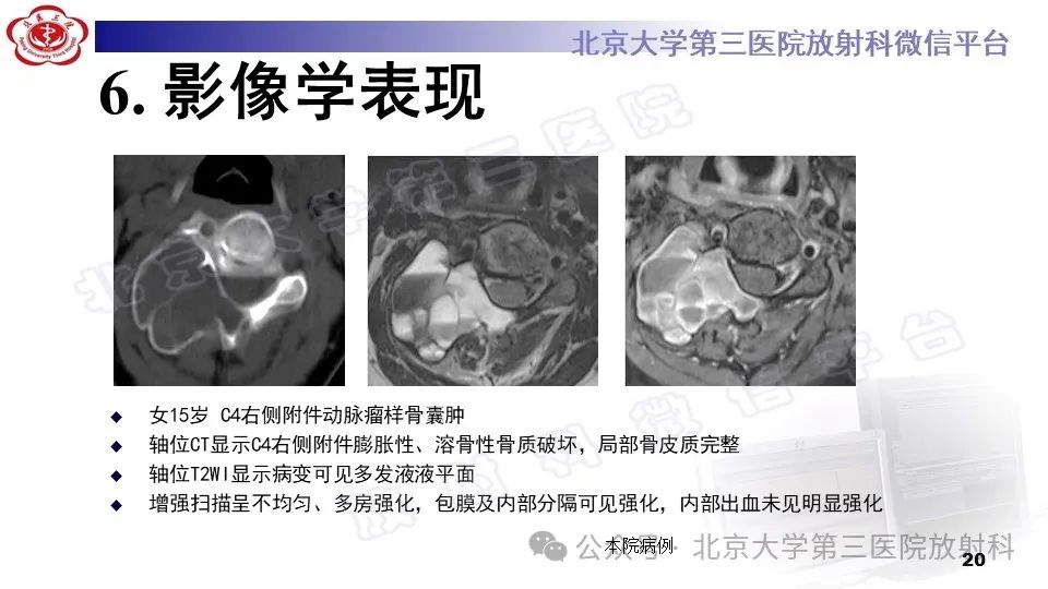 影像PPT - 【PPT】胸椎动脉瘤样骨囊肿-19