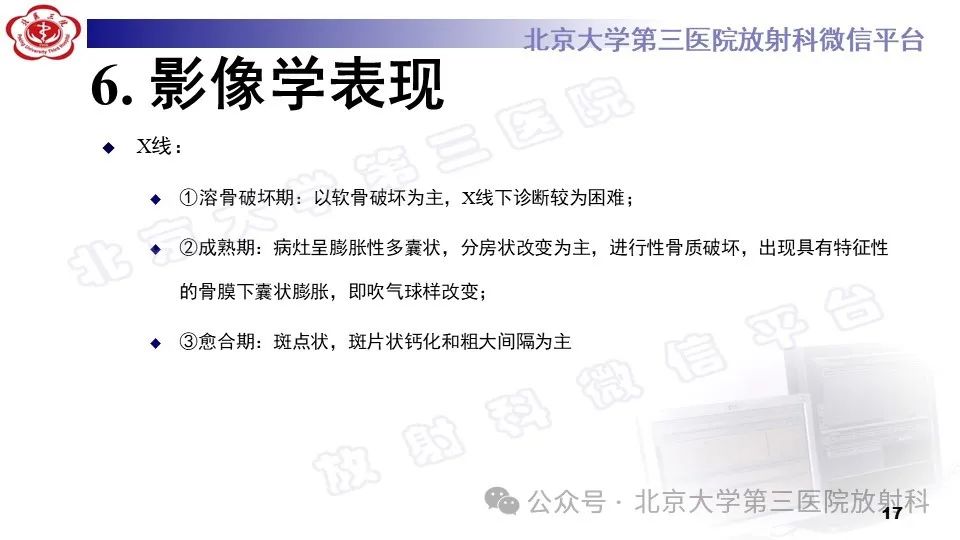 影像PPT - 【PPT】胸椎动脉瘤样骨囊肿-16