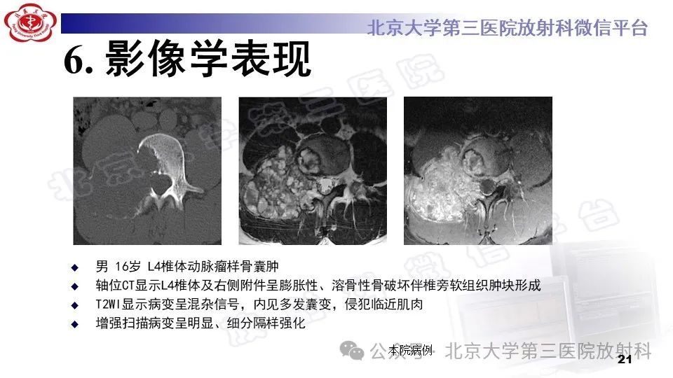 影像PPT - 【PPT】胸椎动脉瘤样骨囊肿-20