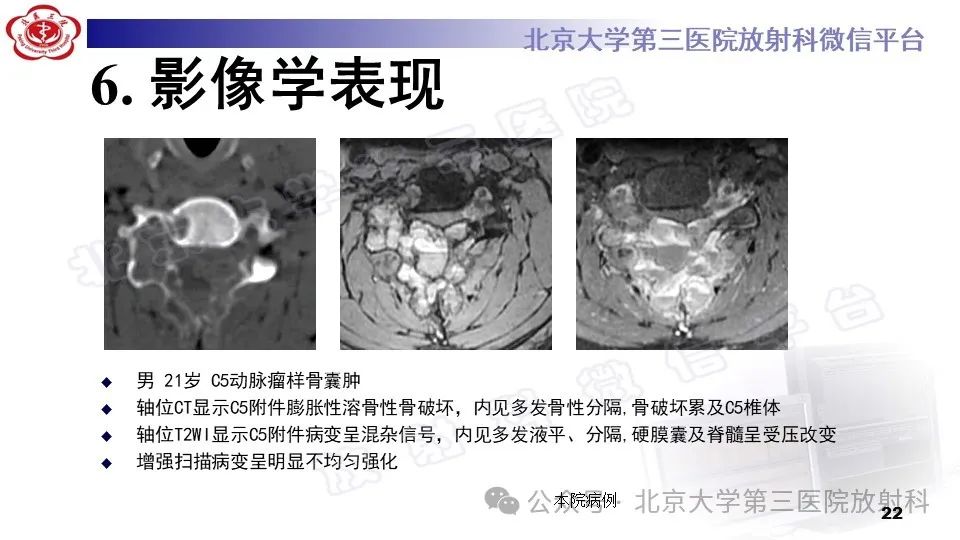 影像PPT - 【PPT】胸椎动脉瘤样骨囊肿-21