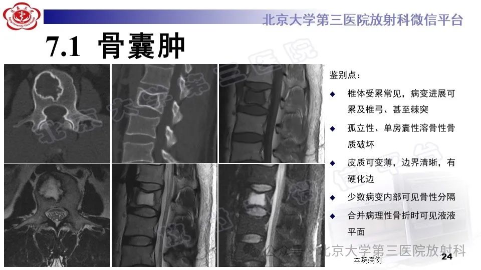 影像PPT - 【PPT】胸椎动脉瘤样骨囊肿-23