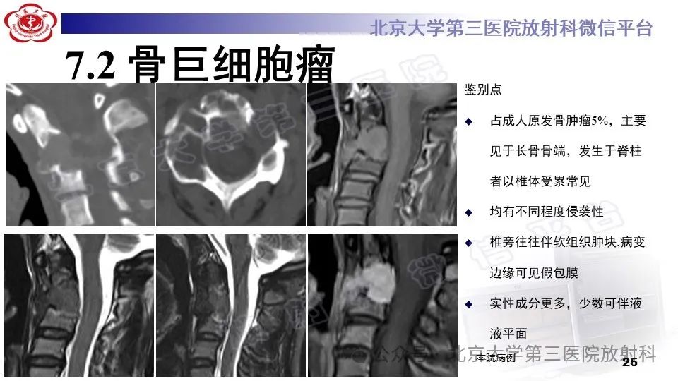 影像PPT - 【PPT】胸椎动脉瘤样骨囊肿-24
