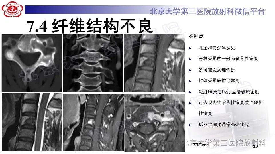 影像PPT - 【PPT】胸椎动脉瘤样骨囊肿-26