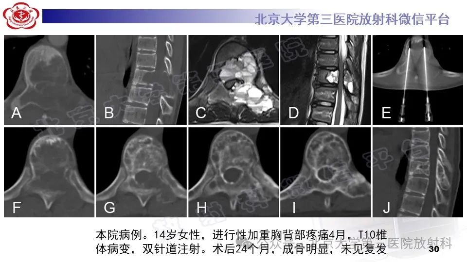 影像PPT - 【PPT】胸椎动脉瘤样骨囊肿-29